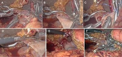 Preliminary experience on laparoscopic pancreaticoduodenal combined with major venous resection and reconstruction anastomosis